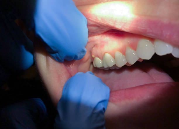 Tooth Infection Emergency Dentist in NC